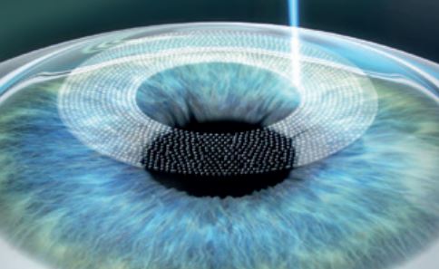 Refractive&nbsp;Surgery